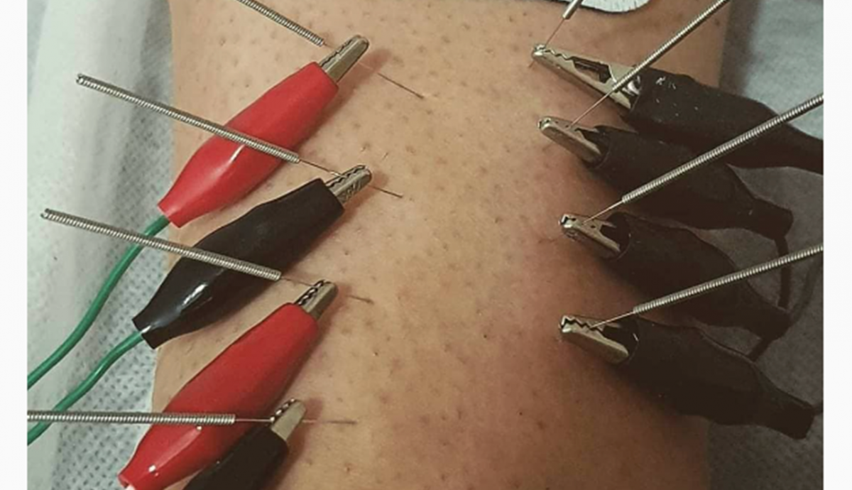 Electroterapia Electroterapia
