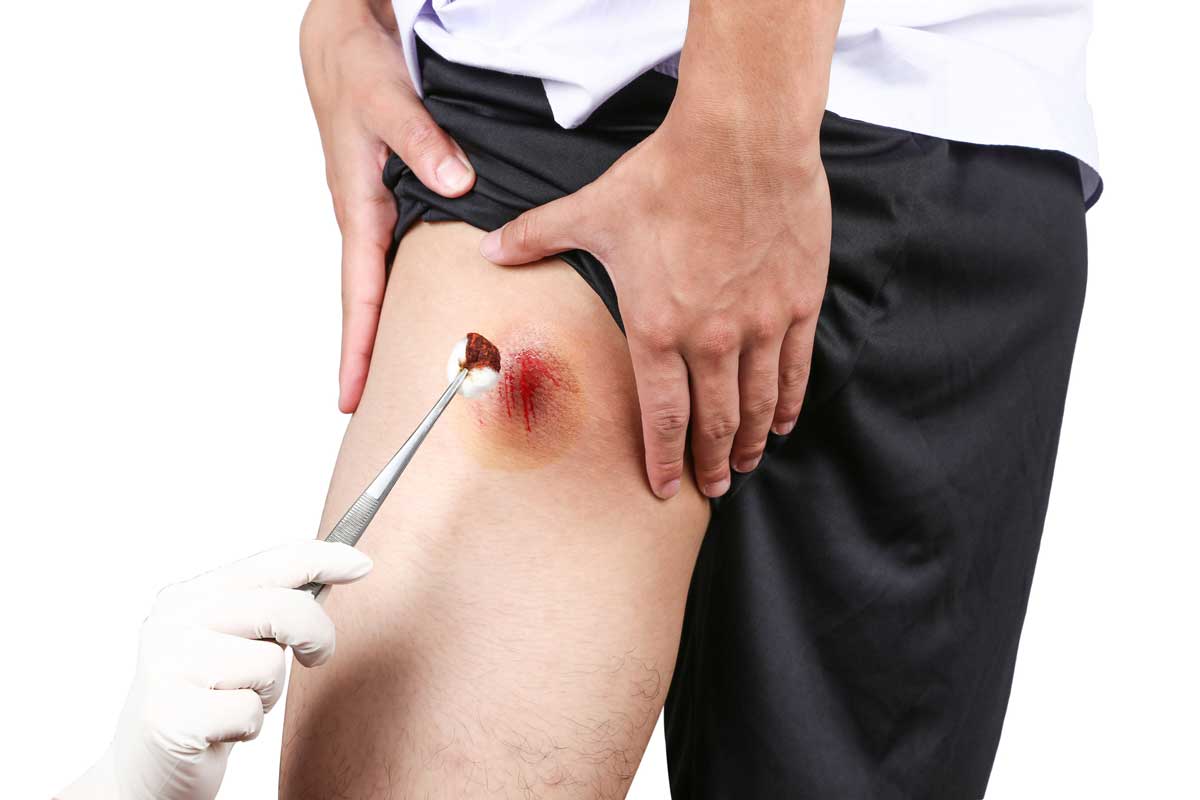 Por aquí uno que casi lo hace bien... está usando povidona yodada, ¡correcto!, pero la aplica con algodón, ¡incorrecto! (Foto: iStock)