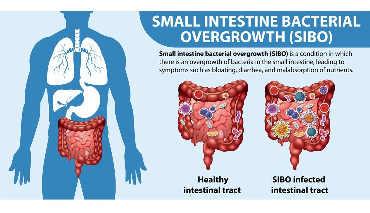 SIBO, la enfermedad intestinal. Síntomas