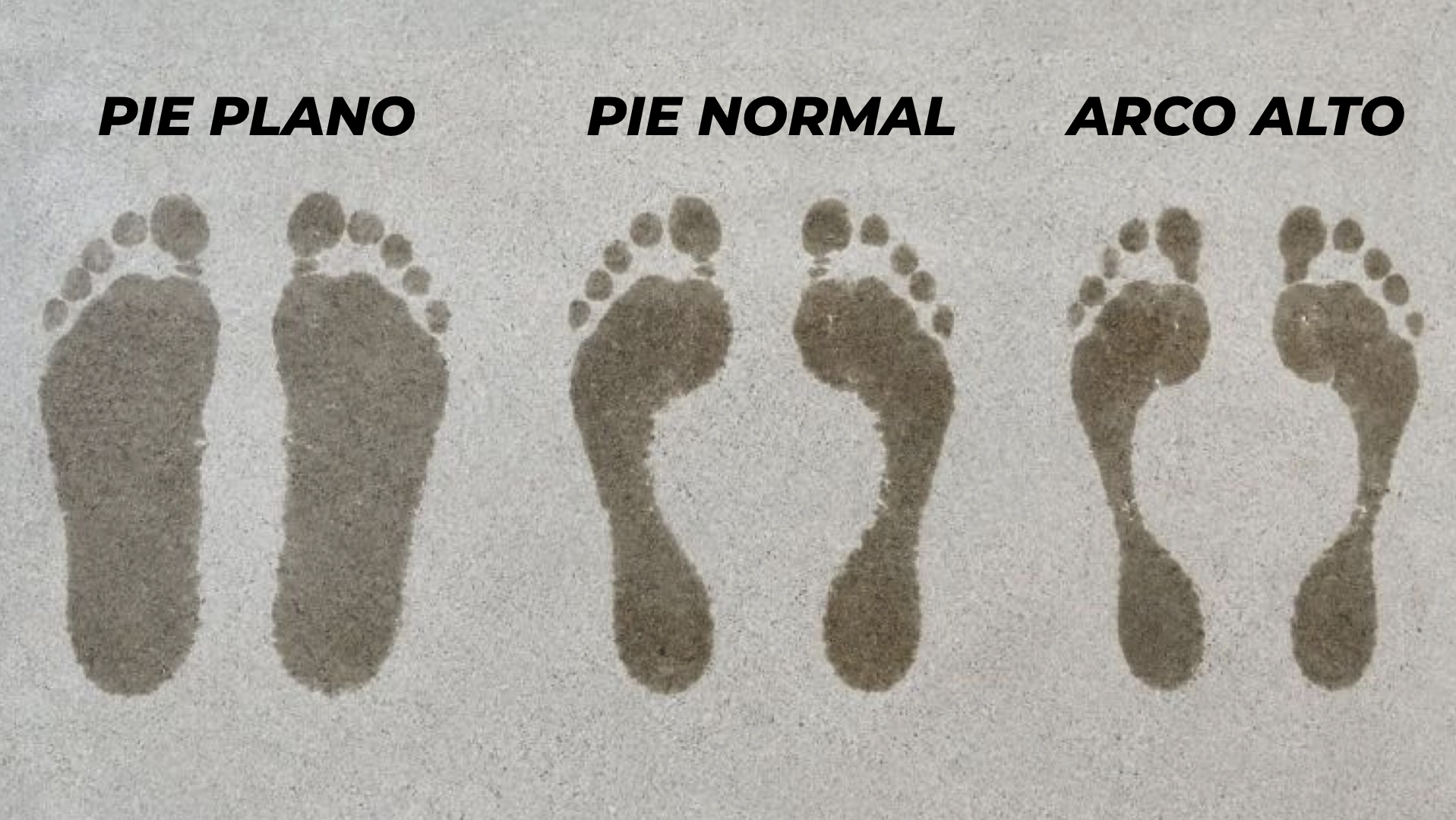 Comparativa de la huella de un pie normal, con pie plano o de arco alto.