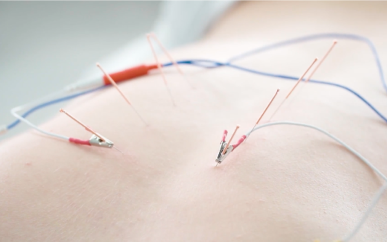 Neuromodulación funcional percutánea