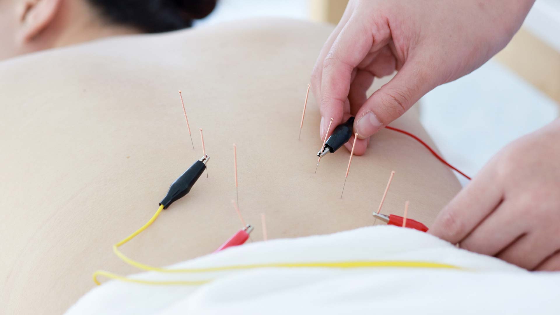 Neuromodulación funcional percutánea. (Foto: iStock)
