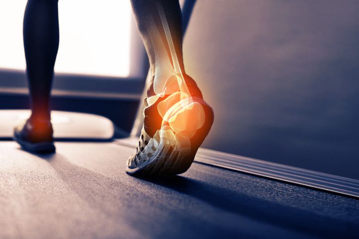 La fascitis plantar, una de las lesiones típicas del verano