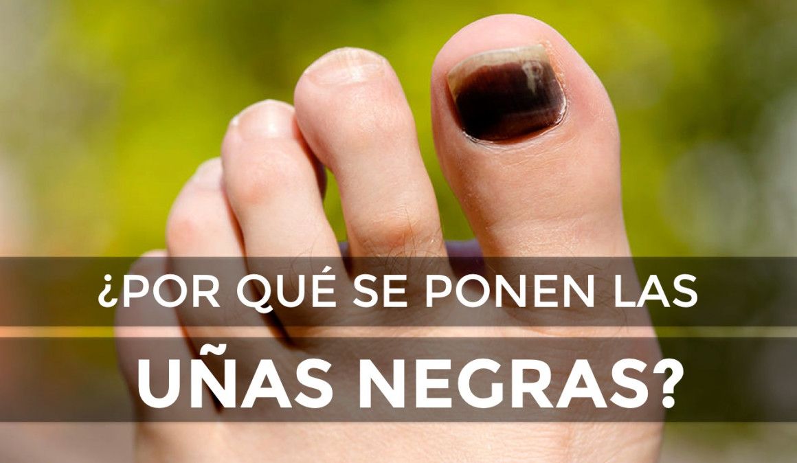 ¿Por qué se ponen las uñas negras?