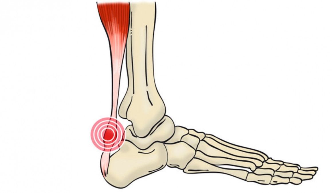 Cómo superar la tendinitis aquilea y volver a correr antes