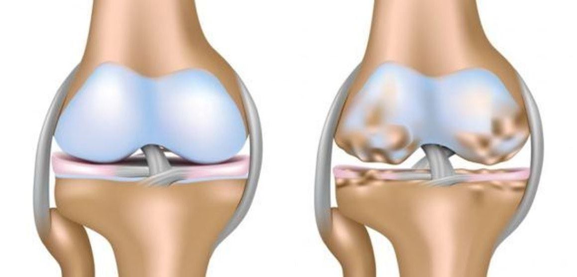 ¿Cómo puedo recuperarme de la condromalacia?