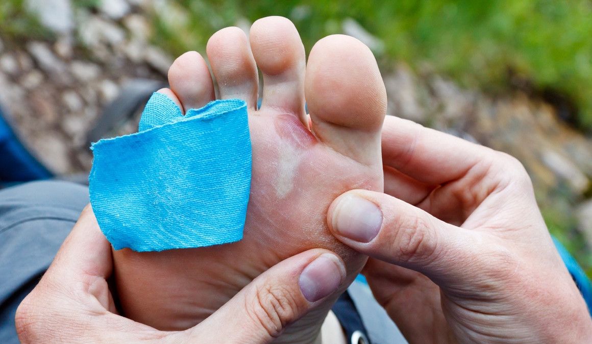Las ampollas son habituales entre los corredores | iStock