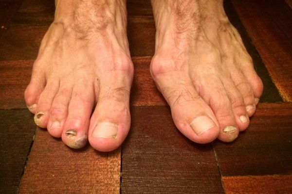 Los pies más feos que jamás has visto