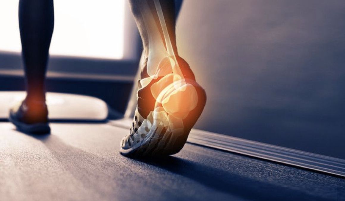 ¿Cuánto dura la fascitis plantar? Foto: iStock