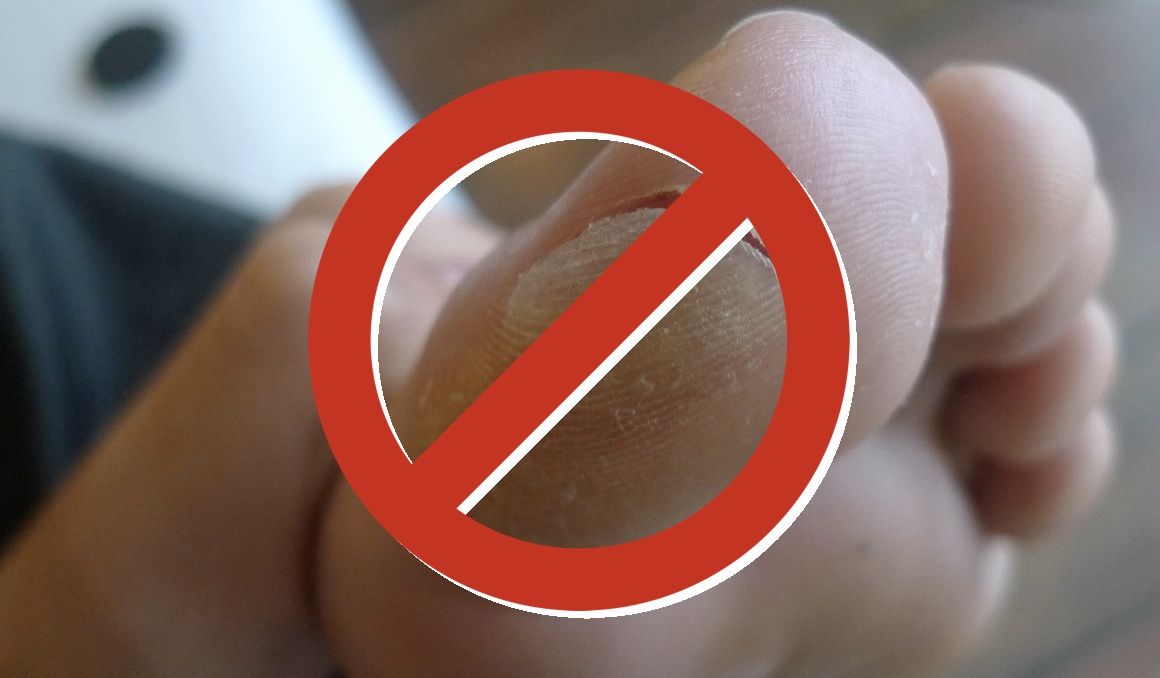 Cómo cuidar el pie para evitar ampollas