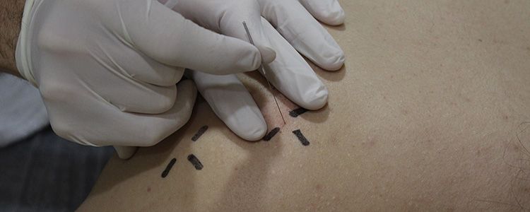 Conoce una nueva forma de recuperar lesiones: la Neuromodulación Funcional Percutánea Conoce una nueva forma de recuperar lesiones: la Neuromodulación Funcional Percutánea